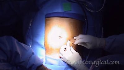 Appendectomy for ruptured appendicitis